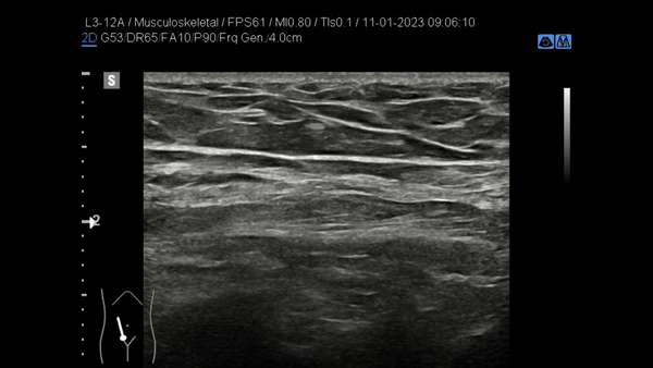 Cliprefreshmentbuikwand